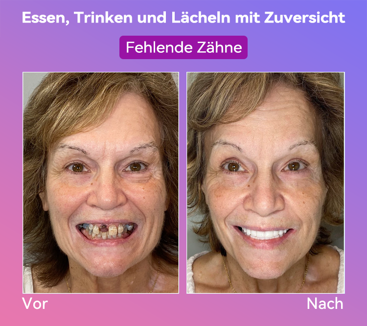 𝐉𝐚𝐬𝐬𝐞𝐞𝐦® Neueste Premium-Komfort-Zahnersätze🎁(Hochwertige Zahnersätze, Bequem zu Tragen - 70% Rabatt für begrenzte Zeit)