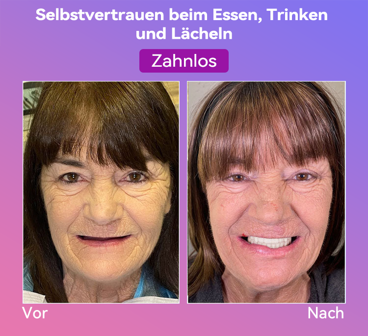 𝐉𝐚𝐬𝐬𝐞𝐞𝐦® Neueste Premium-Komfort-Zahnersätze🎁(Hochwertige Zahnersätze, Bequem zu Tragen - 70% Rabatt für begrenzte Zeit)