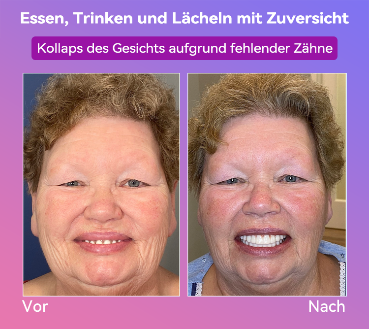 𝐉𝐚𝐬𝐬𝐞𝐞𝐦® Neueste Premium-Komfort-Zahnersätze🎉 (Hochwertige Zahnersätze, Bequem zu Tragen - 70% Rabatt für begrenzte Zeit)🔥