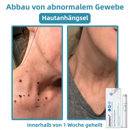 𝐉𝐚𝐬𝐬𝐞𝐞𝐦®💧𝐍𝐢𝐜𝐡𝐭-𝐢𝐧𝐯𝐚𝐬𝐢𝐯 𝐋𝐞𝐛𝐞𝐫𝐟𝐥𝐞𝐜𝐤- 𝐮𝐧𝐝 𝐖𝐚𝐫𝐳𝐞𝐧𝐞𝐧𝐭𝐟𝐞𝐫𝐧𝐮𝐧𝐠𝐬-𝐋𝐚𝐬𝐞𝐫𝐬𝐭𝐢𝐟𝐭 (Schnelle und schmerzlose Entfernung von Warzen, Muttermalen, Altersflecken und Hautflecken – ohne Nebenwirkungen)