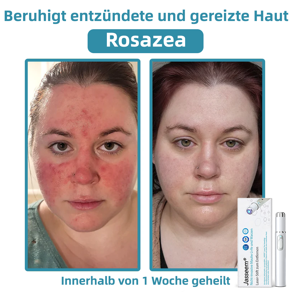 𝐉𝐚𝐬𝐬𝐞𝐞𝐦®💧𝐍𝐢𝐜𝐡𝐭-𝐢𝐧𝐯𝐚𝐬𝐢𝐯 𝐋𝐞𝐛𝐞𝐫𝐟𝐥𝐞𝐜𝐤- 𝐮𝐧𝐝 𝐖𝐚𝐫𝐳𝐞𝐧𝐞𝐧𝐭𝐟𝐞𝐫𝐧𝐮𝐧𝐠𝐬-𝐋𝐚𝐬𝐞𝐫𝐬𝐭𝐢𝐟𝐭 (Schnelle und schmerzlose Entfernung von Warzen, Muttermalen, Altersflecken und Hautflecken – ohne Nebenwirkungen)