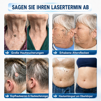 👩‍⚕️🎁 𝑶𝒇𝒇𝒊𝒛𝒊𝒆𝒍𝒍𝒆𝒓 𝑺𝒕𝒐𝒓𝒆 | 𝑵𝐞𝒌𝐢𝐬𝐬® 🌿 𝑴𝒊𝒌𝒓𝒐𝒏𝒂𝒅𝒆𝒍𝒏 𝑴𝒂𝒌𝒆𝒍𝒍𝒐𝒔𝒆 𝑯𝒂𝒖𝒕 𝑯𝒂𝒖𝒕 𝑾𝒂𝒓𝒛𝒆 𝑬𝒏𝒕𝒇𝒆𝒓𝒏𝒖𝒏𝒈 𝑷𝒇𝒍𝒂𝒔𝒕𝒆𝒓 (𝐹ü𝑟 𝐻𝑎𝑢𝑡𝑎𝑛ℎä𝑛𝑔𝑠𝑒𝑙, 𝑘𝑙𝑒𝑖𝑛𝑒 𝐻𝑎𝑢𝑡𝑤𝑢𝑐ℎ𝑒𝑟𝑢𝑛𝑔𝑒𝑛, 𝑊𝑎𝑟𝑧𝑒𝑛, 𝑀𝑢𝑡𝑡𝑒𝑟𝑚𝑎𝑙𝑒, 𝐴𝑙𝑡𝑒𝑟𝑠𝑓𝑙𝑒𝑐𝑘𝑒𝑛 𝑢𝑛𝑑 𝑃𝑖𝑔𝑚𝑒𝑛𝑡𝑠𝑡ö𝑟𝑢𝑛𝑔𝑒𝑛.)