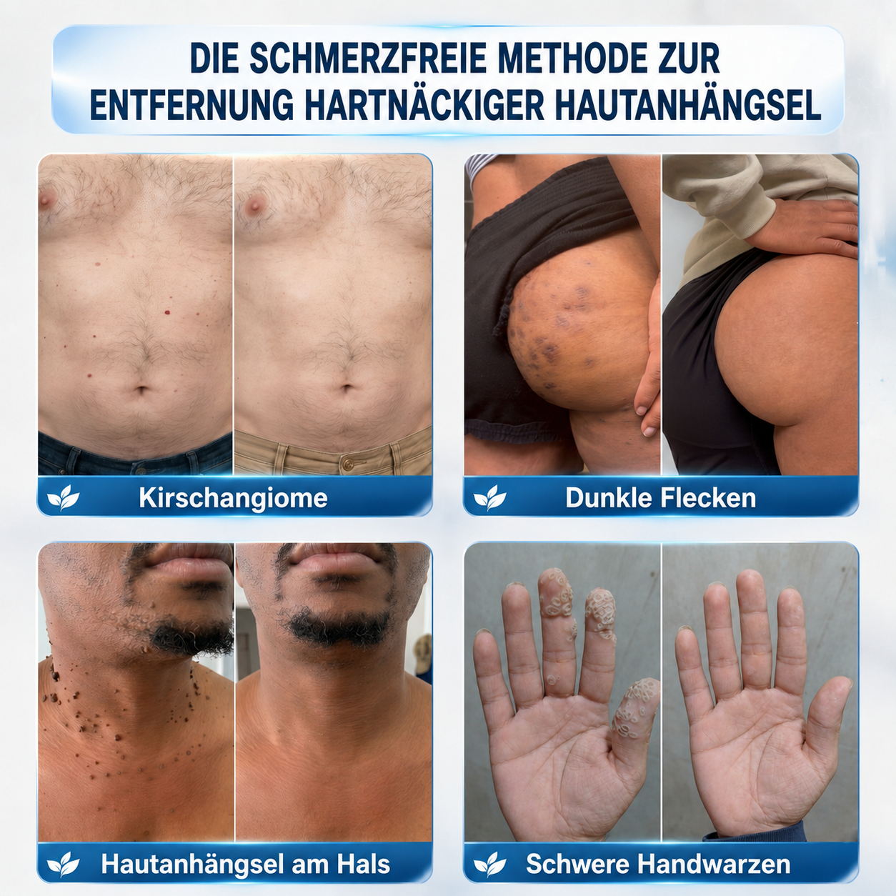 👩‍⚕️🎁 𝑶𝒇𝒇𝒊𝒛𝒊𝒆𝒍𝒍𝒆𝒓 𝑺𝒕𝒐𝒓𝒆 | 𝑵𝐞𝒌𝐢𝐬𝐬® 🌿 𝑴𝒊𝒌𝒓𝒐𝒏𝒂𝒅𝒆𝒍𝒏 𝑴𝒂𝒌𝒆𝒍𝒍𝒐𝒔𝒆 𝑯𝒂𝒖𝒕 𝑯𝒂𝒖𝒕 𝑾𝒂𝒓𝒛𝒆 𝑬𝒏𝒕𝒇𝒆𝒓𝒏𝒖𝒏𝒈 𝑷𝒇𝒍𝒂𝒔𝒕𝒆𝒓 (𝐹ü𝑟 𝐻𝑎𝑢𝑡𝑎𝑛ℎä𝑛𝑔𝑠𝑒𝑙, 𝑘𝑙𝑒𝑖𝑛𝑒 𝐻𝑎𝑢𝑡𝑤𝑢𝑐ℎ𝑒𝑟𝑢𝑛𝑔𝑒𝑛, 𝑊𝑎𝑟𝑧𝑒𝑛, 𝑀𝑢𝑡𝑡𝑒𝑟𝑚𝑎𝑙𝑒, 𝐴𝑙𝑡𝑒𝑟𝑠𝑓𝑙𝑒𝑐𝑘𝑒𝑛 𝑢𝑛𝑑 𝑃𝑖𝑔𝑚𝑒𝑛𝑡𝑠𝑡ö𝑟𝑢𝑛𝑔𝑒𝑛.)